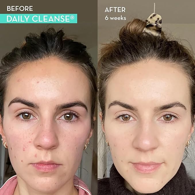 HUM Daily Cleanse Acne Supplement - Gut Cleanse Detox for Clear Skin with Organic Algae, Detoxifying Herbs, Zinc & Spirulina | Clear Skin Supplement (60 Capsules)
